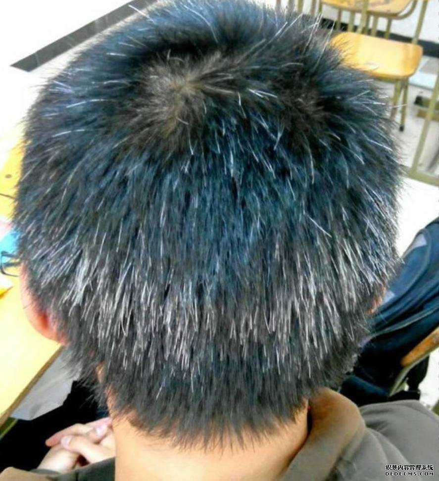 白發(fā)越長越多，并非變老的信號，可能是身體缺乏這3種元素了